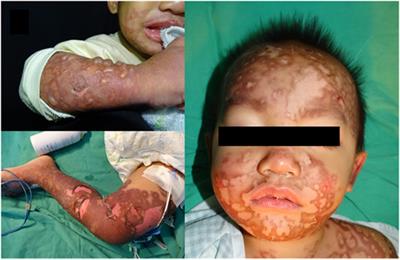 Vancomycin-Induced Stevens-Johnson Syndrome in a Boy Under 2 Years Old: An Early Diagnosis by Granulysin Rapid Test